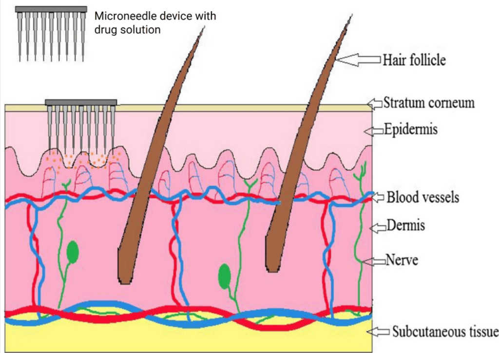 Color-coded cross-sectional diagram of human skin showing microneedle array insertion through the epidermis into the dermis, with labeled structures including blood vessels, nerves, and hair follicles.

